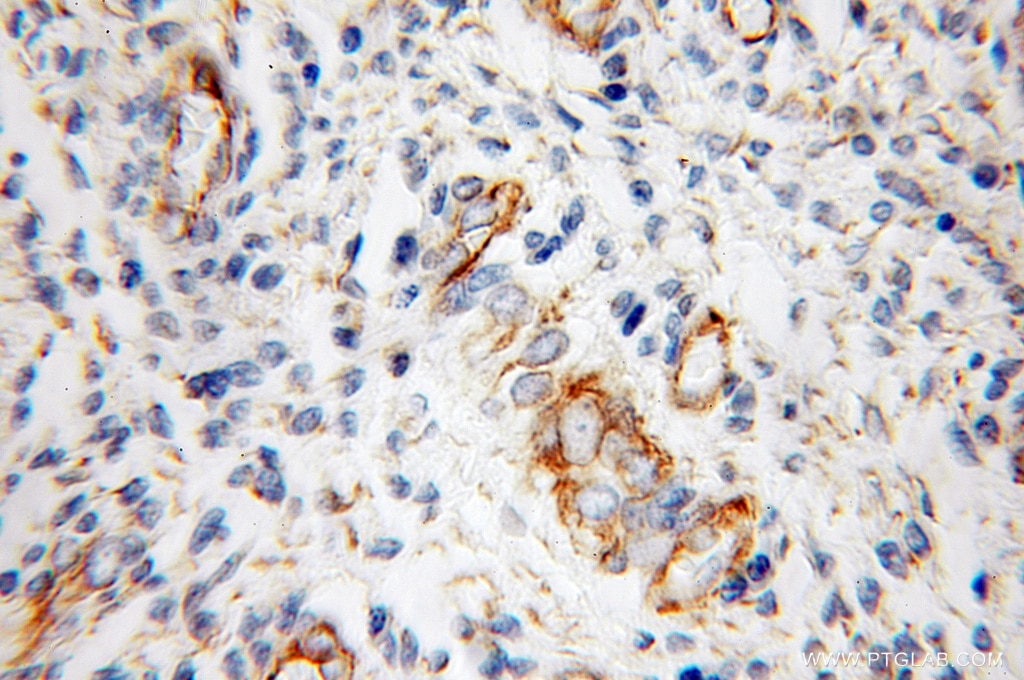 Immunohistochemistry (IHC) staining of human endometrial cancer tissue using Cadherin-13 Polyclonal antibody (12618-1-AP)