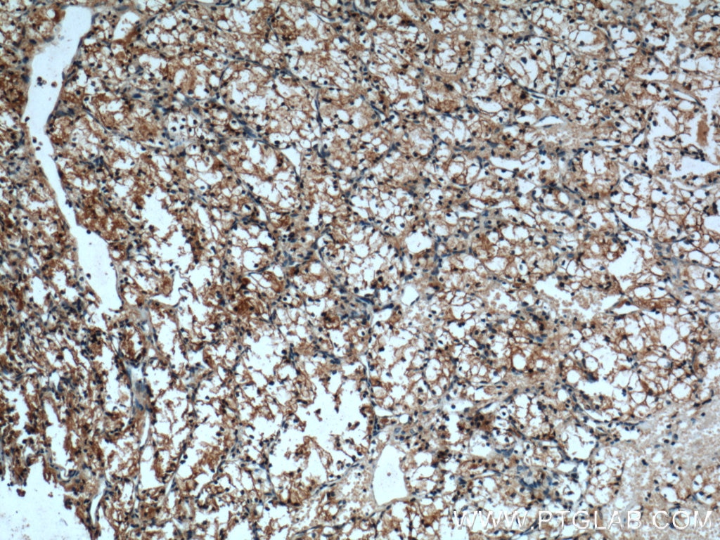 Immunohistochemistry (IHC) staining of human renal cell carcinoma tissue using Cadherin-16 Polyclonal antibody (15107-1-AP)