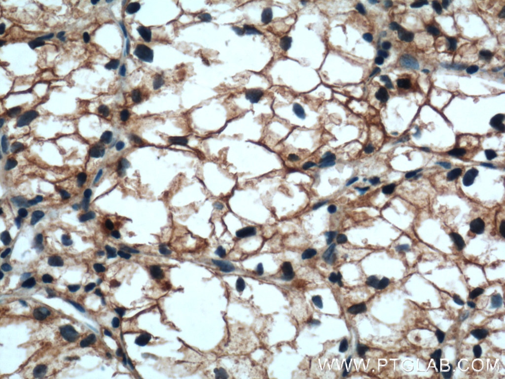 Immunohistochemistry (IHC) staining of human renal cell carcinoma tissue using Cadherin-16 Polyclonal antibody (15107-1-AP)