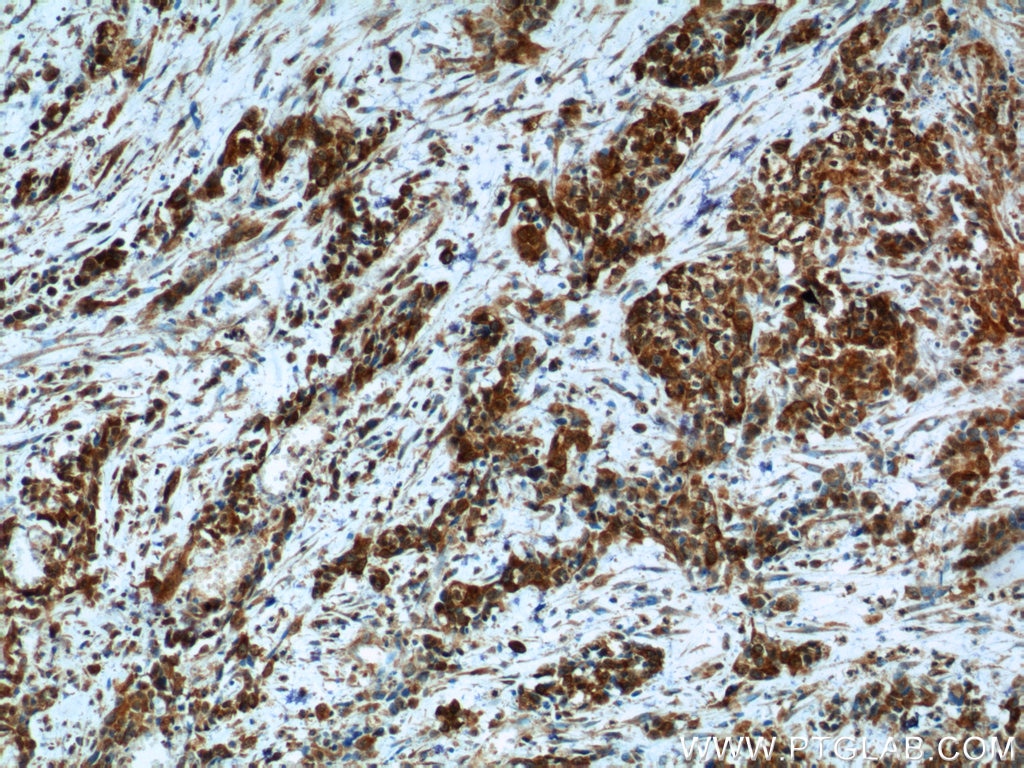Immunohistochemistry (IHC) staining of human stomach cancer tissue using Cadherin-17 Polyclonal antibody (24339-1-AP)