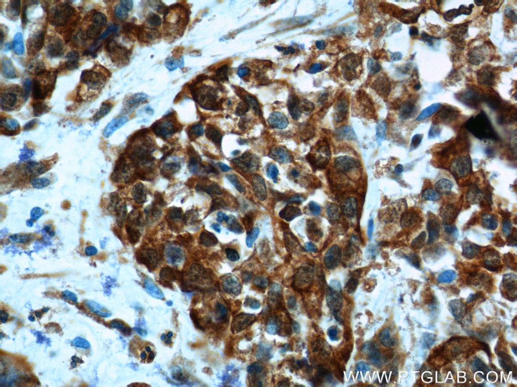 Immunohistochemistry (IHC) staining of human stomach cancer tissue using Cadherin-17 Polyclonal antibody (24339-1-AP)