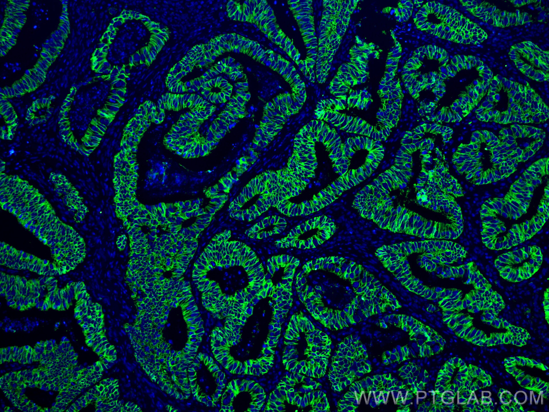 Immunofluorescence (IF) / fluorescent staining of human colon cancer tissue using Cadherin-17 Monoclonal antibody (60351-1-Ig)