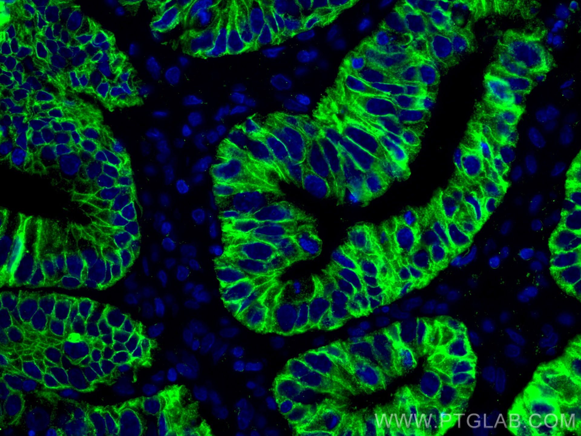 Immunofluorescence (IF) / fluorescent staining of human colon cancer tissue using Cadherin-17 Monoclonal antibody (60351-1-Ig)