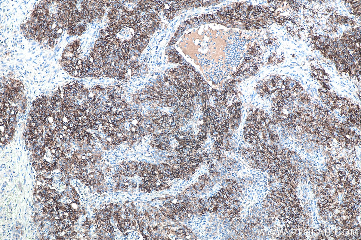 Immunohistochemistry (IHC) staining of human stomach cancer tissue using Cadherin-17 Monoclonal antibody (60351-1-Ig)