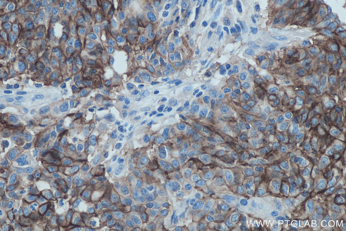 Immunohistochemistry (IHC) staining of human stomach cancer tissue using Cadherin-17 Monoclonal antibody (60351-1-Ig)