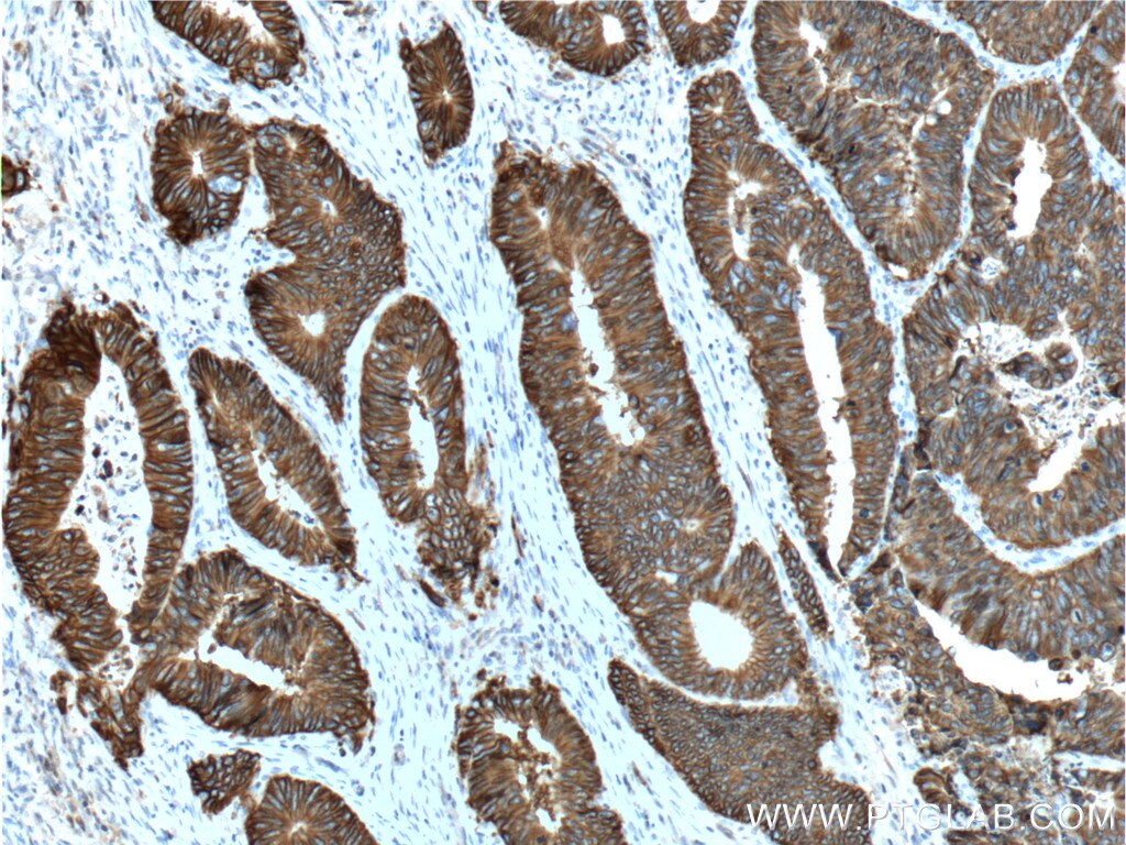 Immunohistochemistry (IHC) staining of human colon cancer tissue using Cadherin-17 Monoclonal antibody (60351-1-Ig)