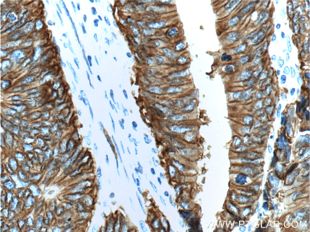 Immunohistochemistry (IHC) staining of human colon cancer tissue using Cadherin-17 Monoclonal antibody (60351-1-Ig)