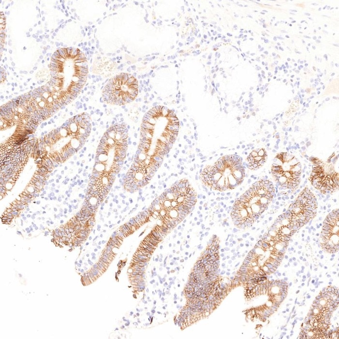 Immunohistochemistry (IHC) staining of human stomach cancer tissue using Cadherin-17 Monoclonal antibody (60351-1-Ig)