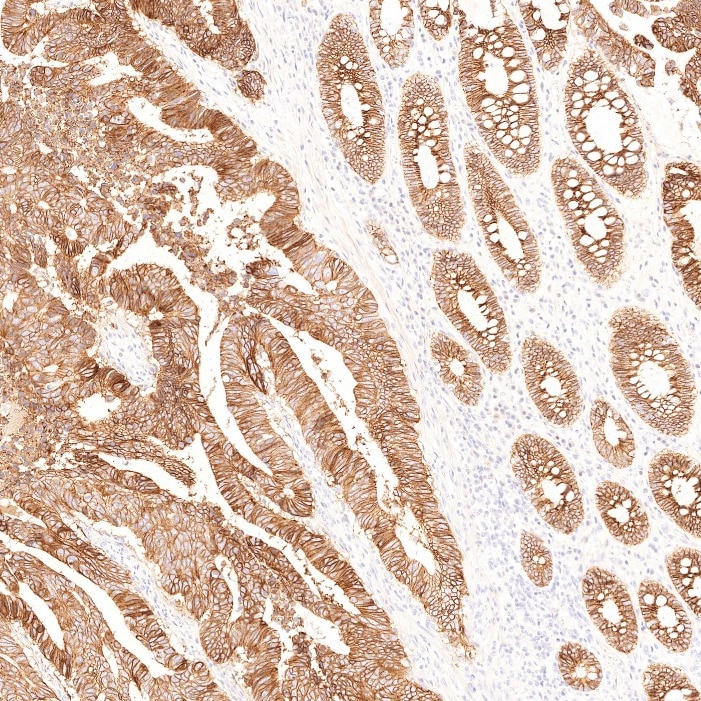 Immunohistochemistry (IHC) staining of human colorectal cancer tissue using Cadherin-17 Monoclonal antibody (60351-1-Ig)