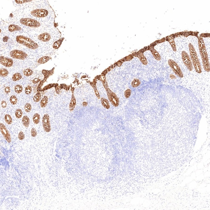 Immunohistochemistry (IHC) staining of human appendicitis tissue using Cadherin-17 Monoclonal antibody (60351-1-Ig)