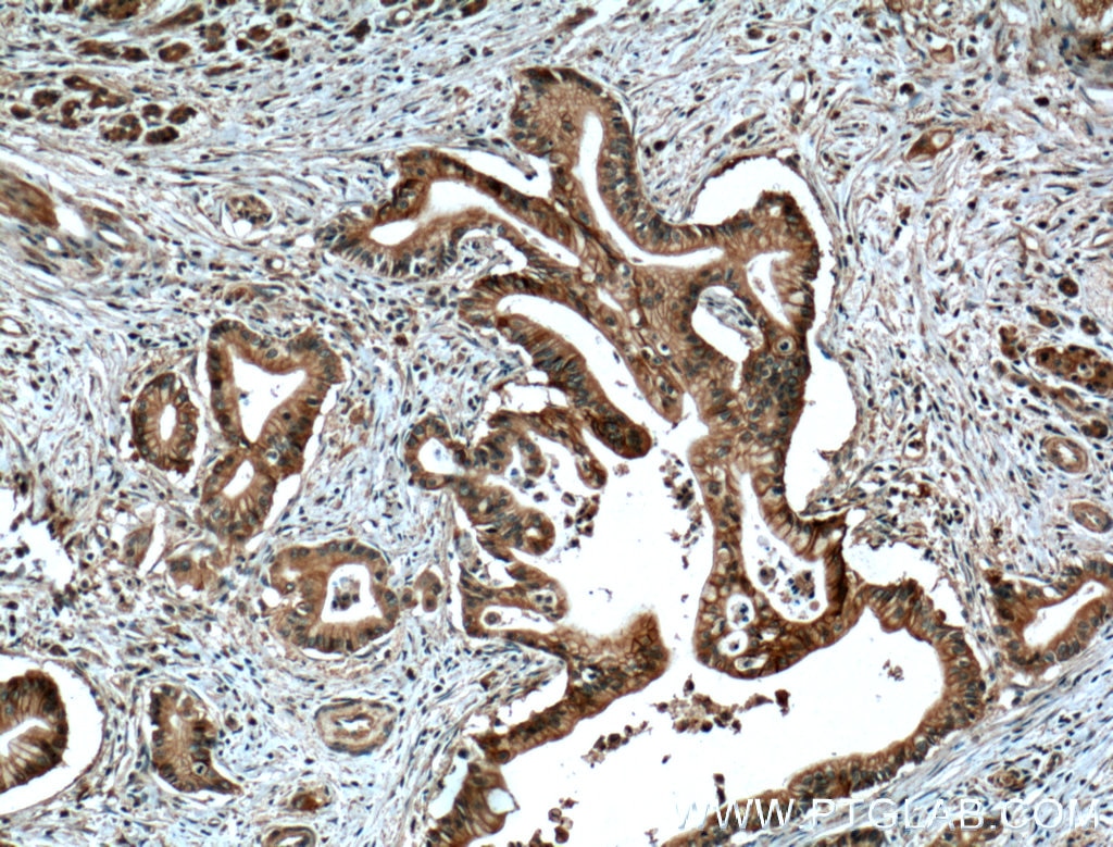 Immunohistochemistry (IHC) staining of human pancreas cancer tissue using Cadherin-17 Monoclonal antibody (60351-1-Ig)
