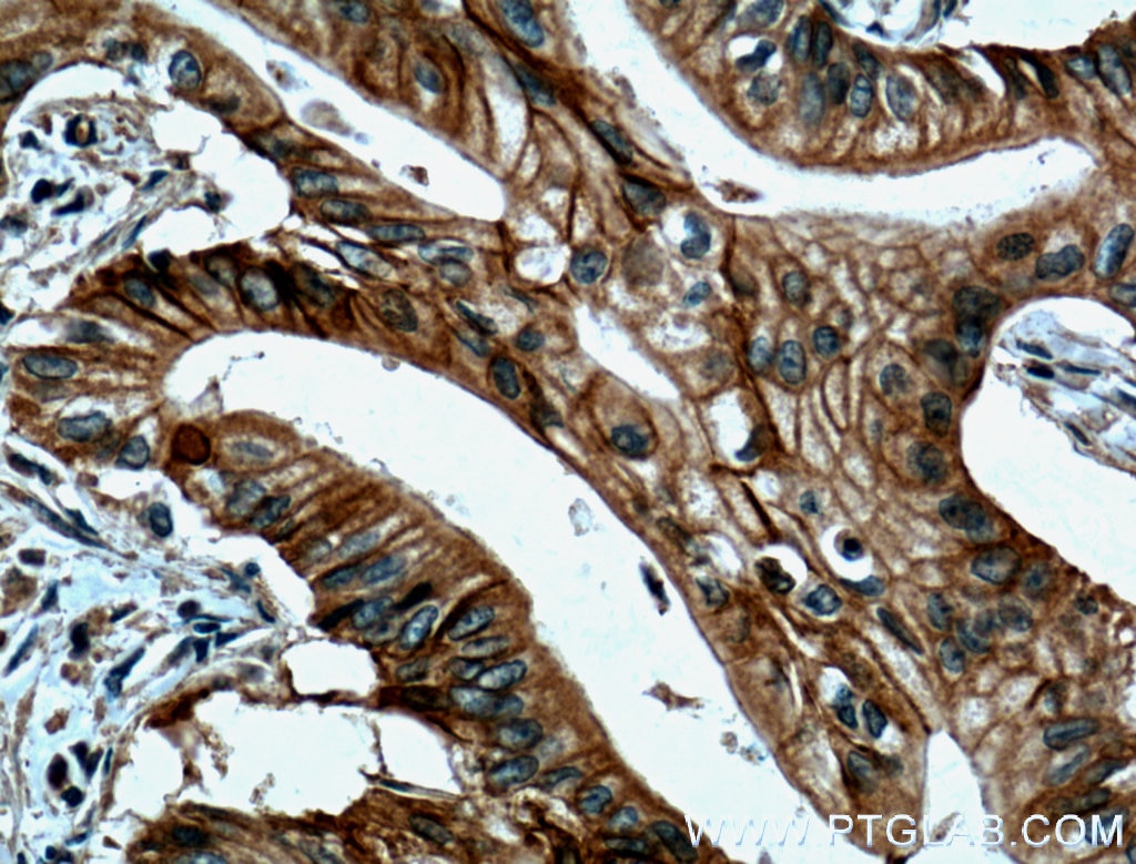 Immunohistochemistry (IHC) staining of human pancreas cancer tissue using Cadherin-17 Monoclonal antibody (60351-1-Ig)