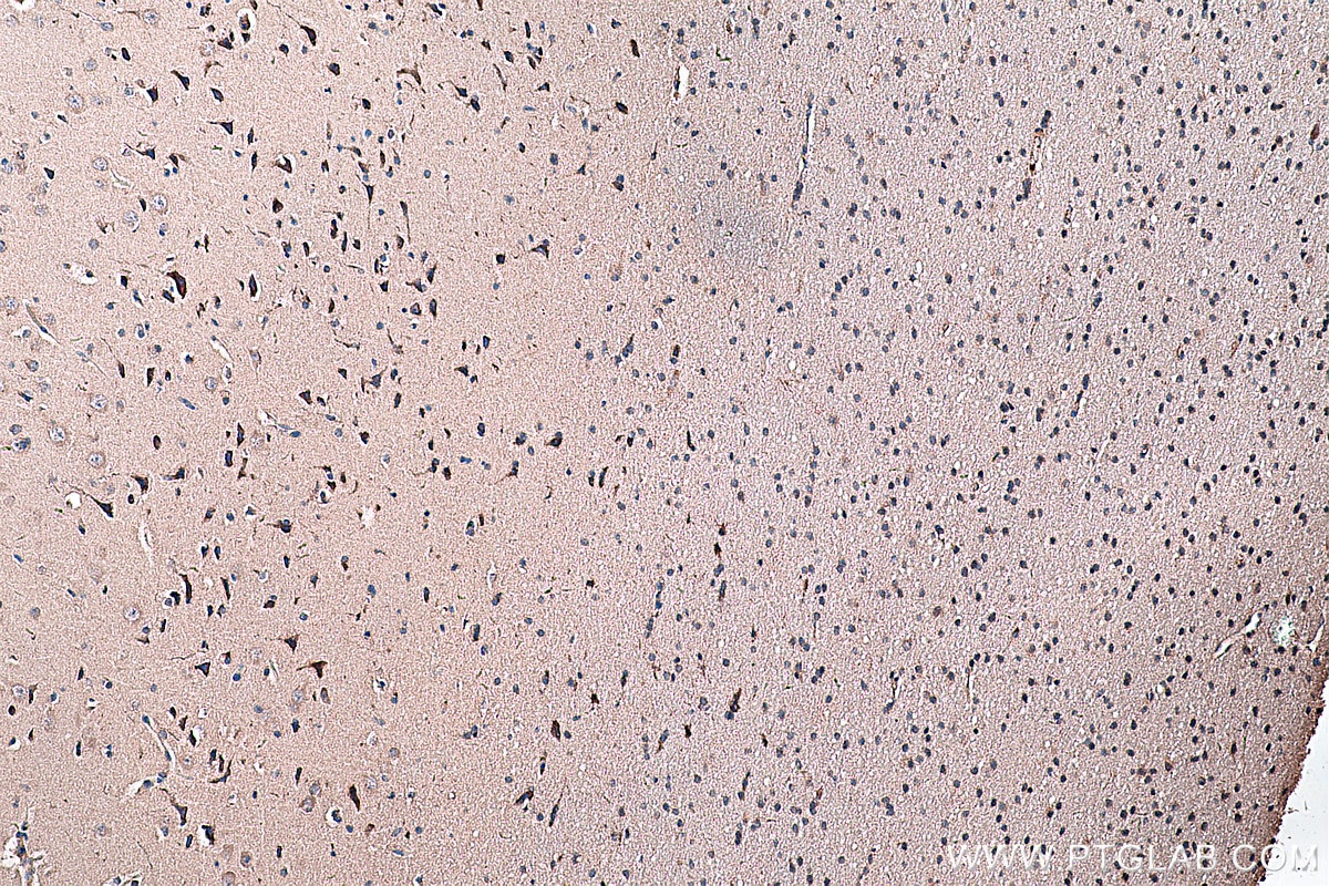 Immunohistochemistry (IHC) staining of human gliomas tissue using Cadherin-18 Polyclonal antibody (13091-1-AP)