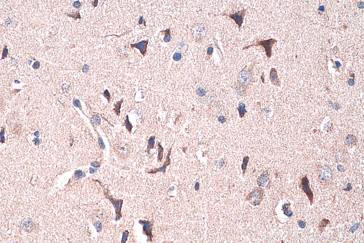 Immunohistochemistry (IHC) staining of human gliomas tissue using Cadherin-18 Polyclonal antibody (13091-1-AP)
