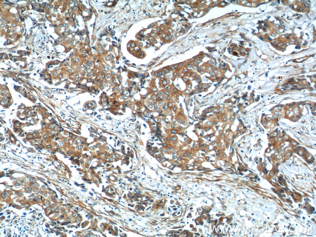 Immunohistochemistry (IHC) staining of human breast cancer tissue using CDH26 Polyclonal antibody (20057-1-AP)