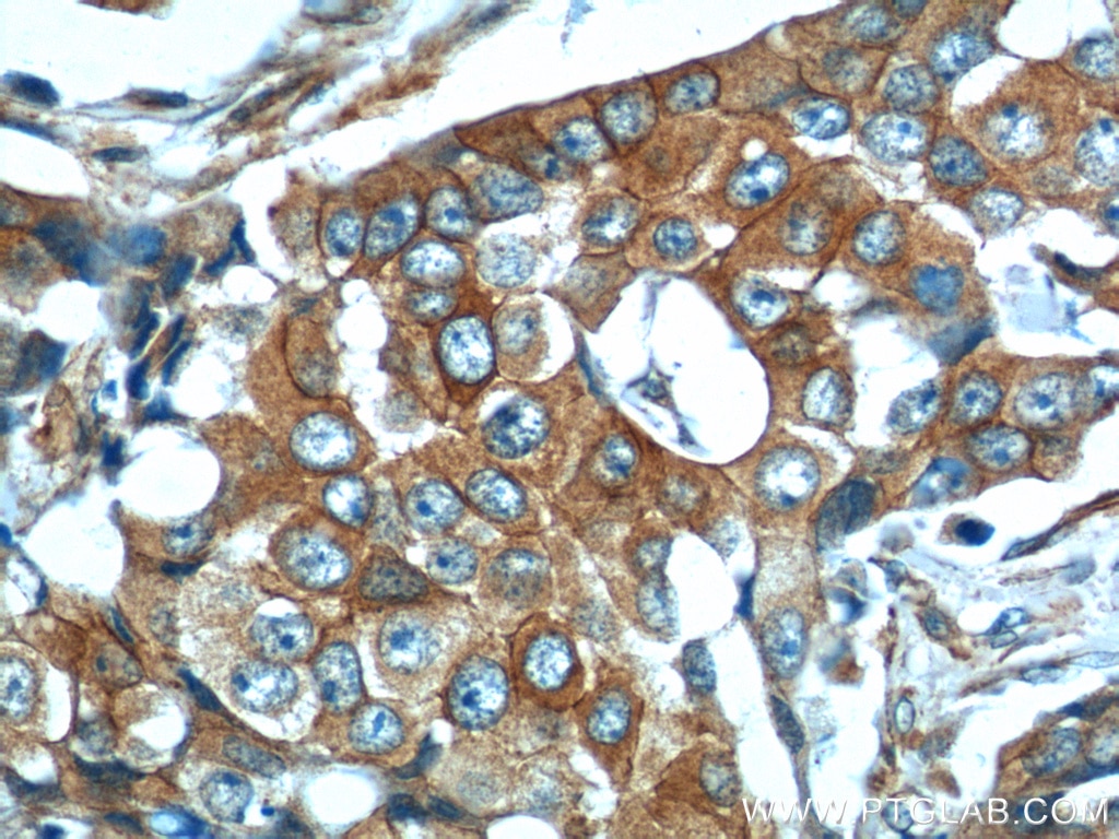 Immunohistochemistry (IHC) staining of human breast cancer tissue using CDH26 Polyclonal antibody (20057-1-AP)