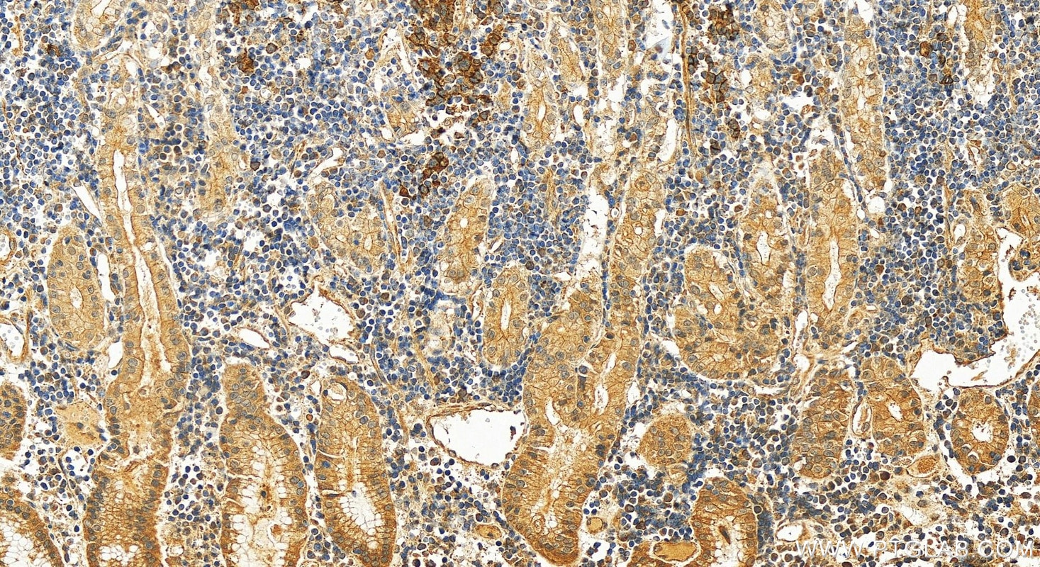 Immunohistochemistry (IHC) staining of human stomach cancer tissue using P-cadherin Polyclonal antibody (13773-1-AP)