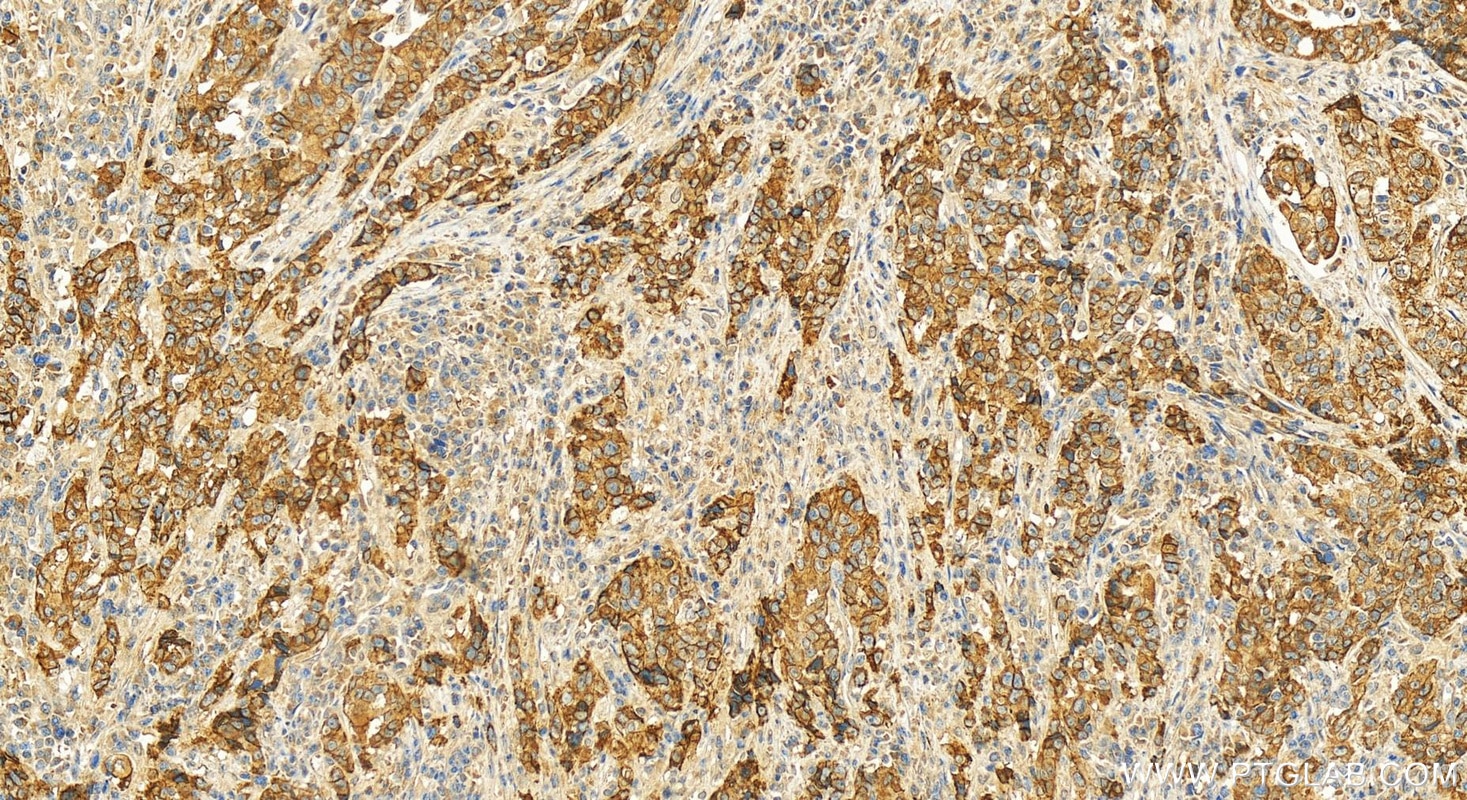 Immunohistochemistry (IHC) staining of human stomach cancer tissue using P-cadherin Polyclonal antibody (13773-1-AP)