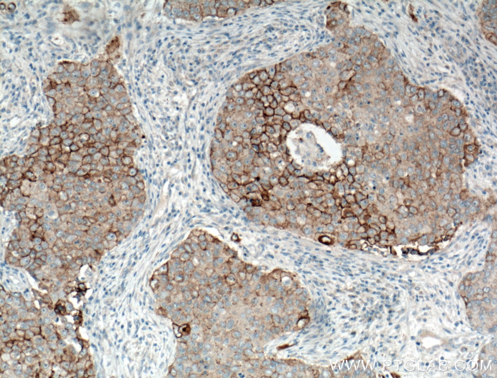 Immunohistochemistry (IHC) staining of human breast cancer tissue using P-cadherin Polyclonal antibody (13773-1-AP)