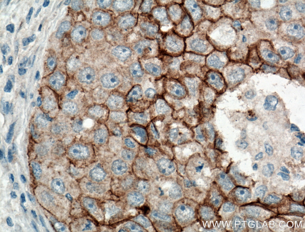 Immunohistochemistry (IHC) staining of human breast cancer tissue using P-cadherin Polyclonal antibody (13773-1-AP)