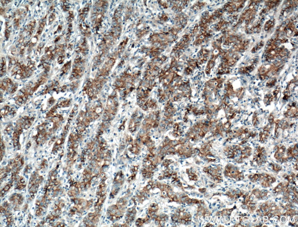 Immunohistochemistry (IHC) staining of human stomach cancer tissue using P-cadherin Polyclonal antibody (13773-1-AP)