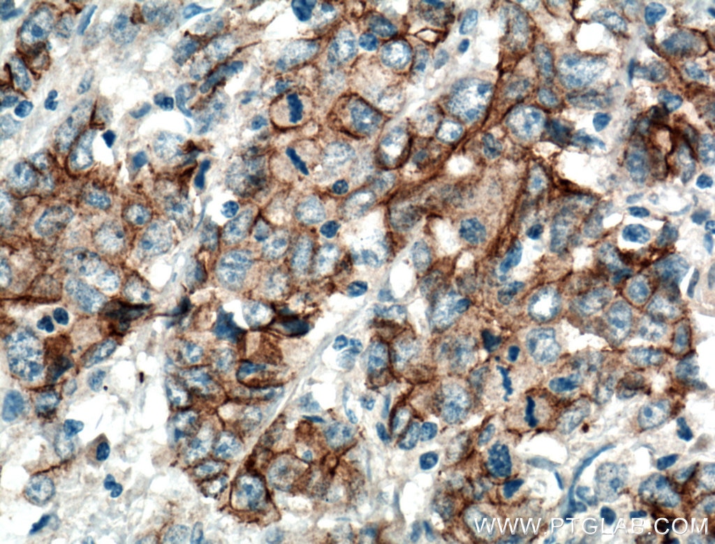 Immunohistochemistry (IHC) staining of human stomach cancer tissue using P-cadherin Polyclonal antibody (13773-1-AP)