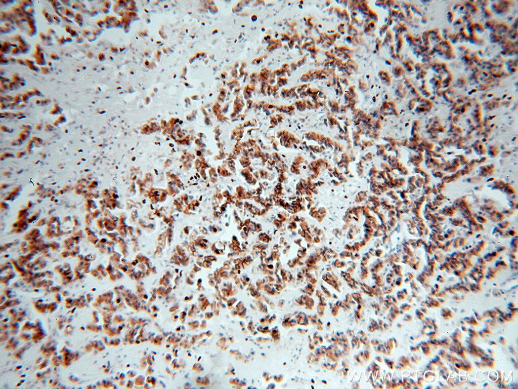 Immunohistochemistry (IHC) staining of human breast cancer tissue using P-cadherin Polyclonal antibody (13773-1-AP)