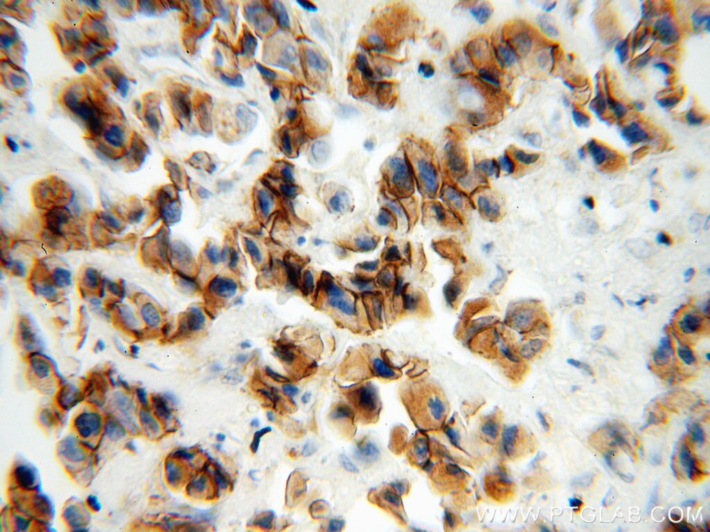 Immunohistochemistry (IHC) staining of human breast cancer tissue using P-cadherin Polyclonal antibody (13773-1-AP)