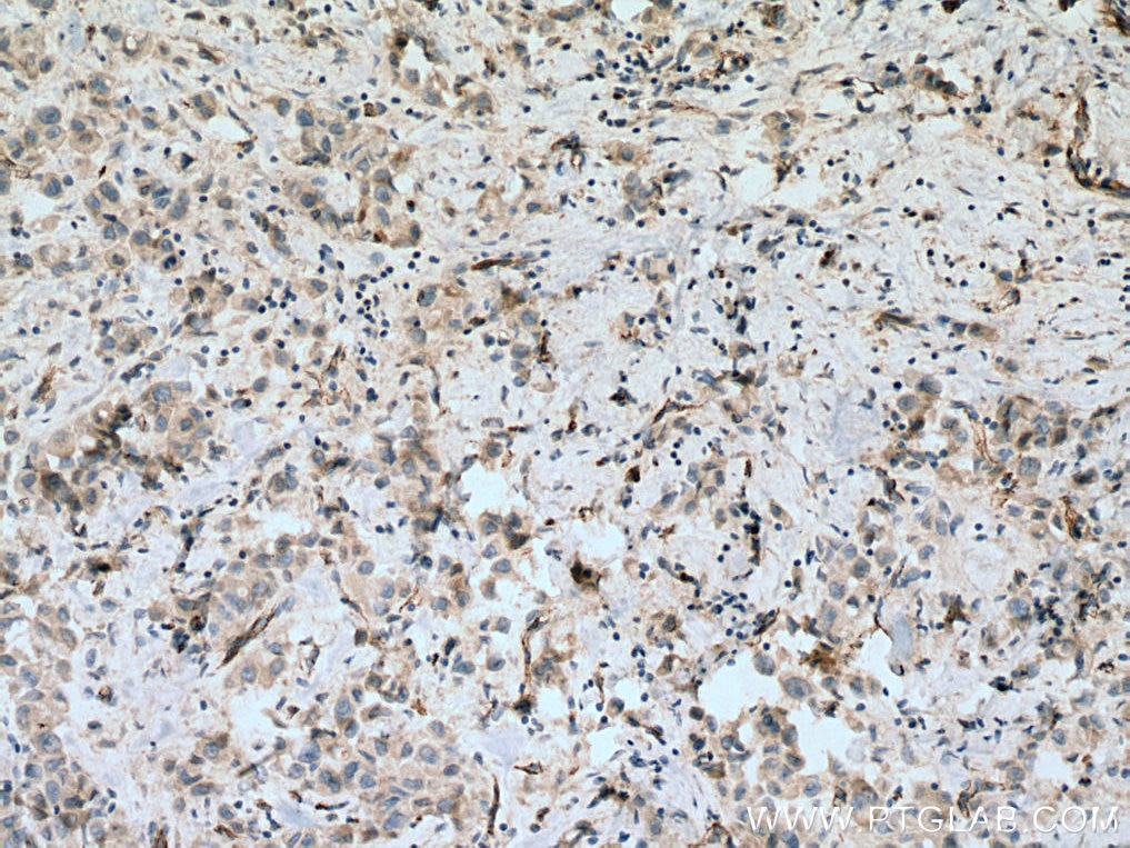 Immunohistochemistry (IHC) staining of human breast cancer tissue using VE-cadherin Polyclonal antibody (27956-1-AP)