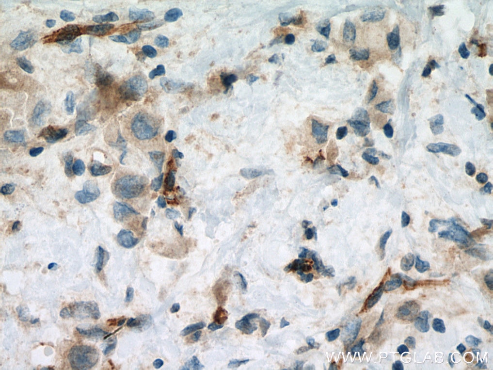 Immunohistochemistry (IHC) staining of human breast cancer tissue using VE-cadherin Polyclonal antibody (27956-1-AP)