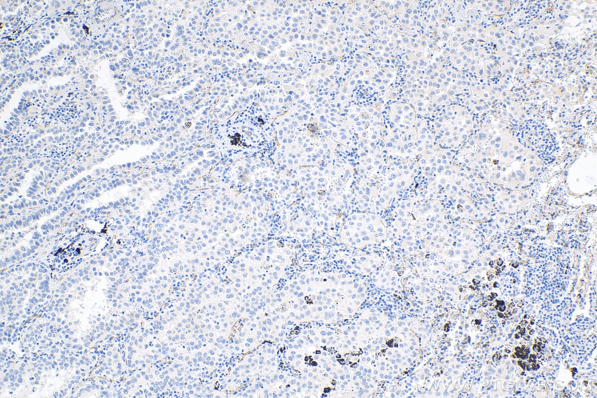 Immunohistochemistry (IHC) staining of human lung cancer tissue using VE-cadherin Polyclonal antibody (27956-1-AP)
