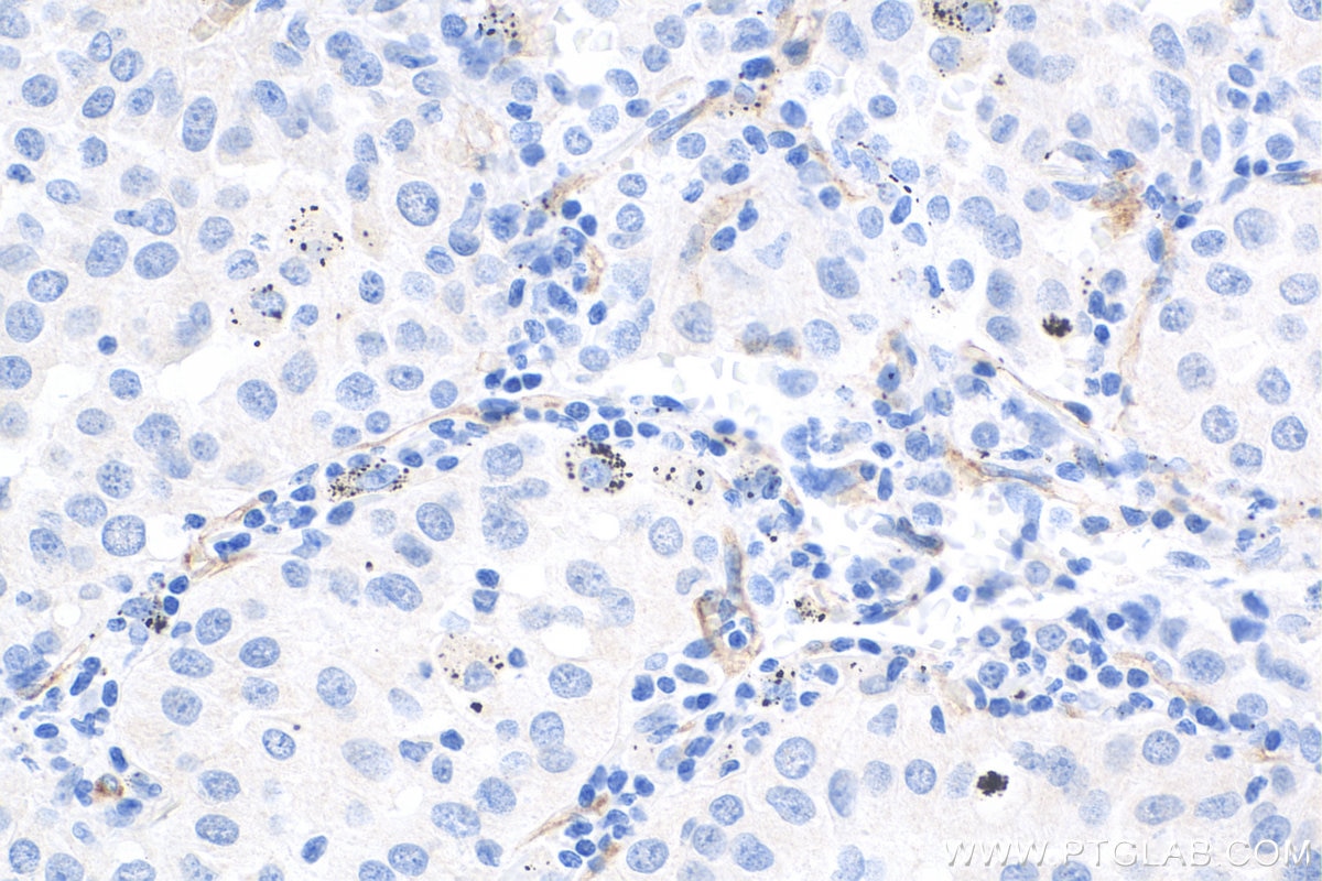 Immunohistochemistry (IHC) staining of human lung cancer tissue using VE-cadherin Polyclonal antibody (27956-1-AP)