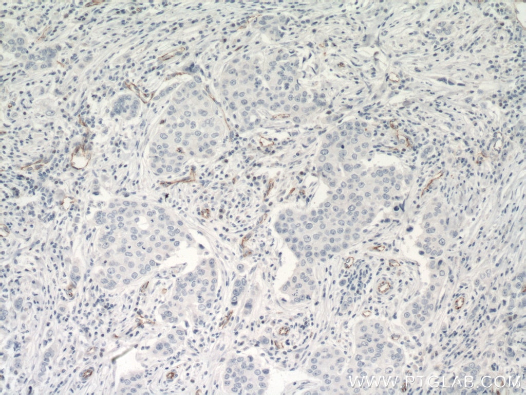 Immunohistochemistry (IHC) staining of human breast cancer tissue using VE-cadherin Monoclonal antibody (66804-1-Ig)