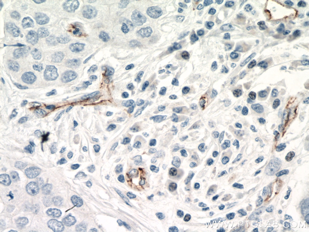 Immunohistochemistry (IHC) staining of human breast cancer tissue using VE-cadherin Monoclonal antibody (66804-1-Ig)
