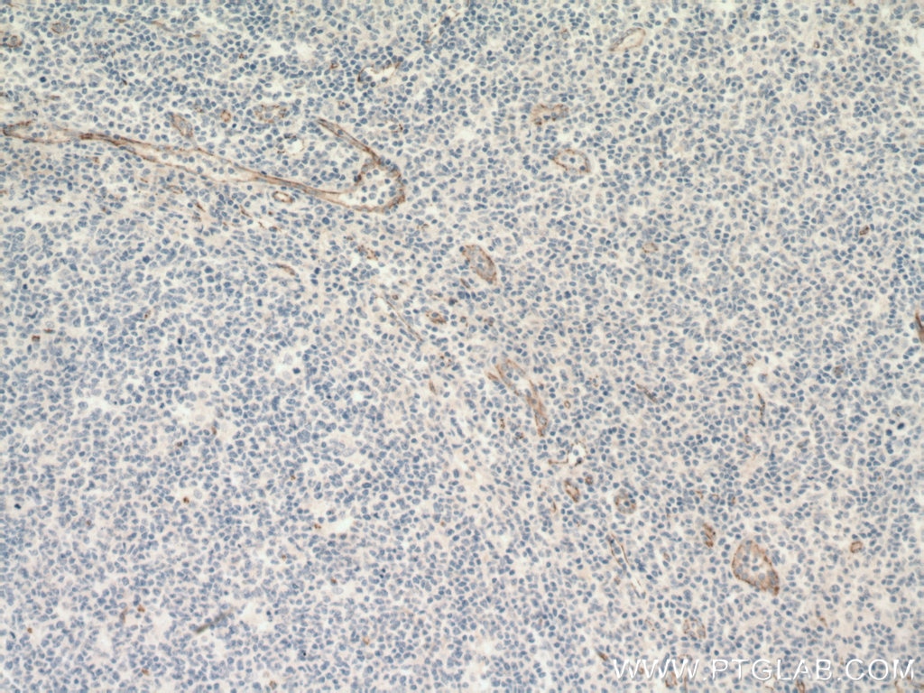 Immunohistochemistry (IHC) staining of human tonsillitis tissue using VE-cadherin Monoclonal antibody (66804-1-Ig)