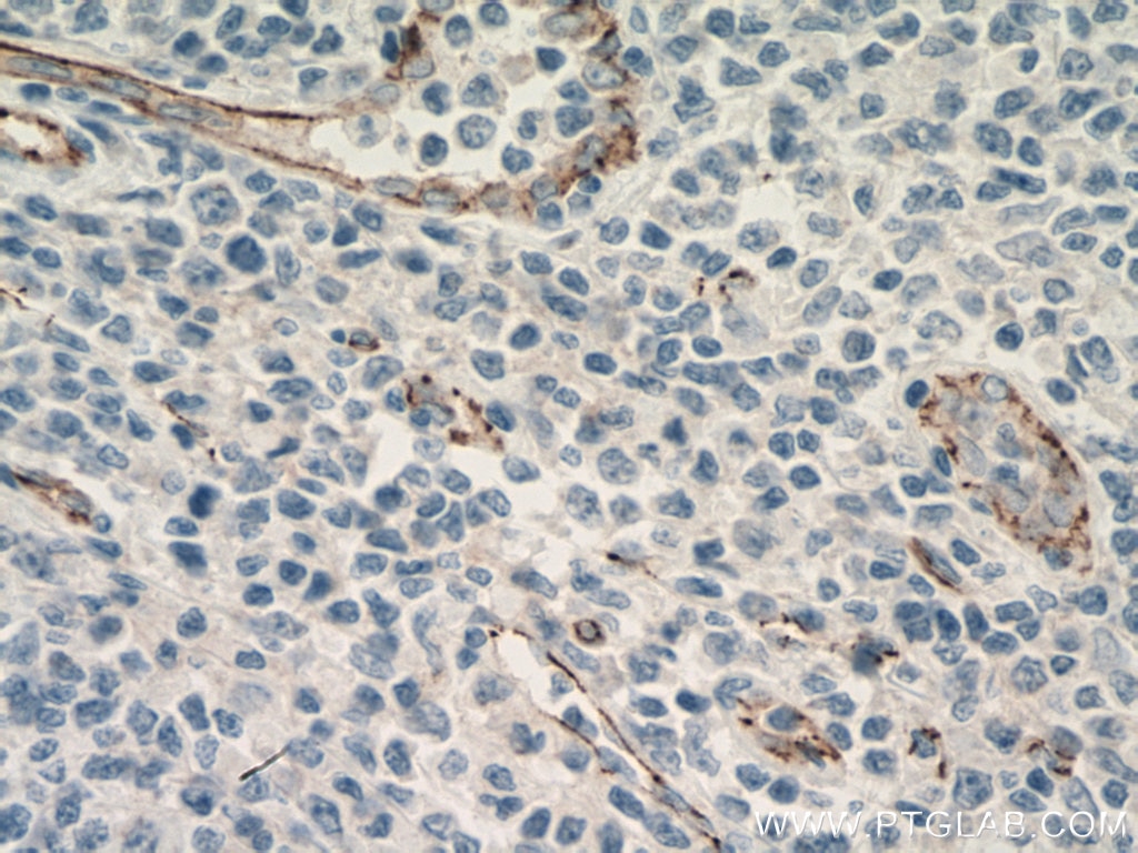 Immunohistochemistry (IHC) staining of human tonsillitis tissue using VE-cadherin Monoclonal antibody (66804-1-Ig)