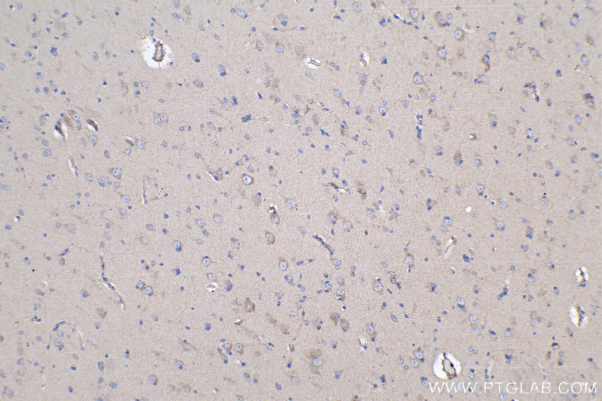 Immunohistochemistry (IHC) staining of human gliomas tissue using Cadherin-7 Polyclonal antibody (13598-1-AP)