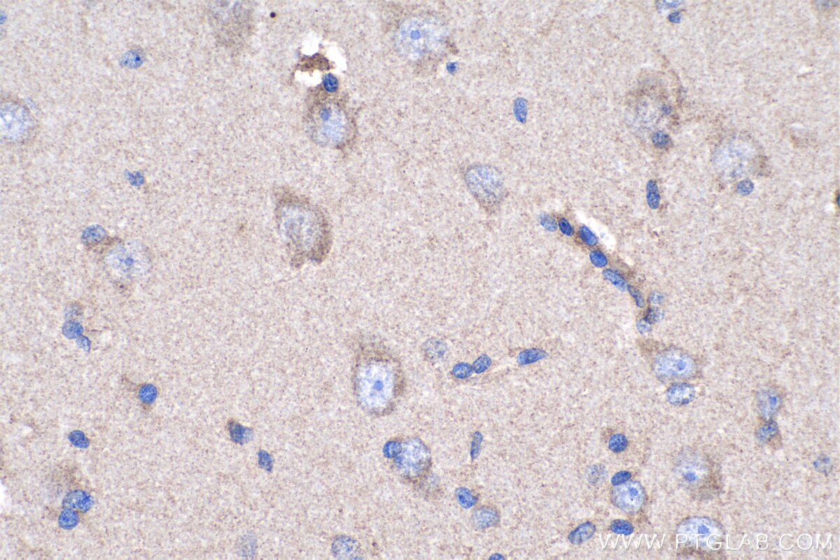 Immunohistochemistry (IHC) staining of human gliomas tissue using Cadherin-7 Polyclonal antibody (13598-1-AP)