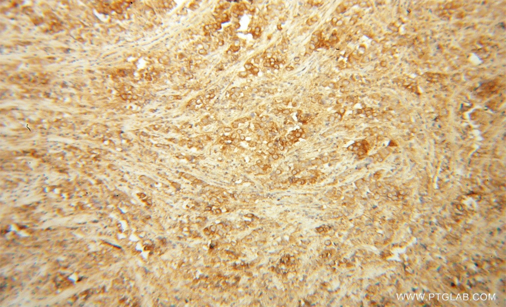 Immunohistochemistry (IHC) staining of human prostate cancer tissue using Cadherin-7 Polyclonal antibody (13598-1-AP)