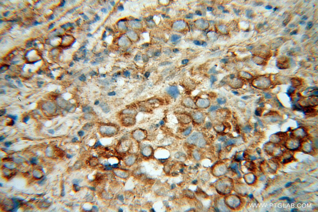 Immunohistochemistry (IHC) staining of human prostate cancer tissue using Cadherin-7 Polyclonal antibody (13598-1-AP)