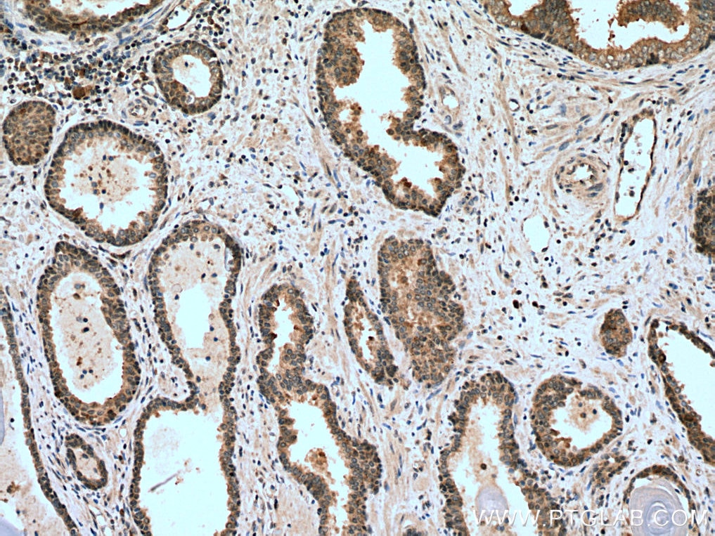 Immunohistochemistry (IHC) staining of human prostate cancer tissue using CDK1 Polyclonal antibody (10762-1-AP)