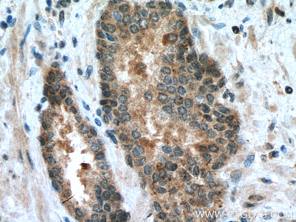 Immunohistochemistry (IHC) staining of human prostate cancer tissue using CDK1 Polyclonal antibody (10762-1-AP)