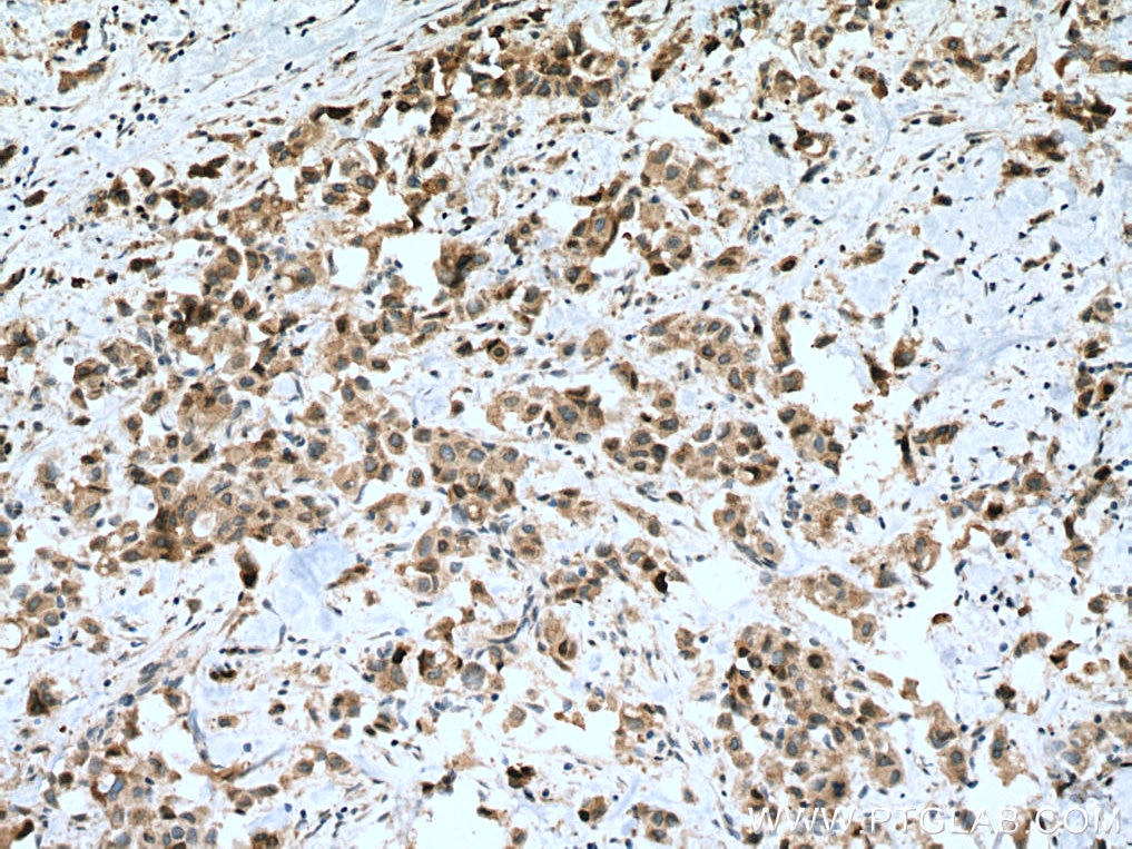Immunohistochemistry (IHC) staining of human breast cancer tissue using CDK1 Polyclonal antibody (10762-1-AP)