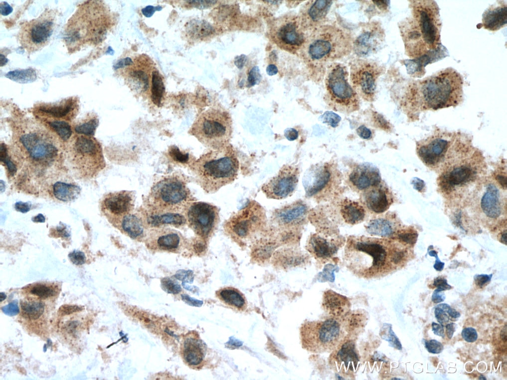 Immunohistochemistry (IHC) staining of human breast cancer tissue using CDK1 Polyclonal antibody (10762-1-AP)