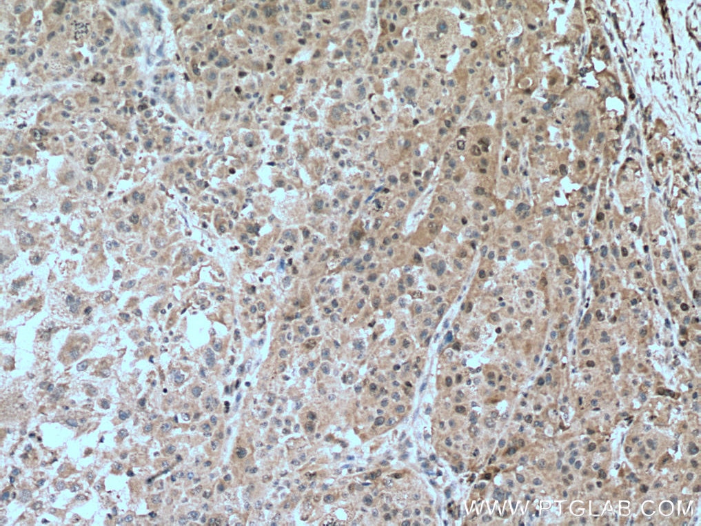 Immunohistochemistry (IHC) staining of human liver cancer tissue using CDK2 Polyclonal antibody (10122-1-AP)