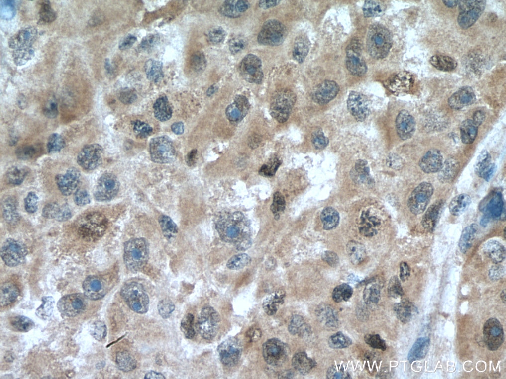 Immunohistochemistry (IHC) staining of human liver cancer tissue using CDK2 Polyclonal antibody (10122-1-AP)