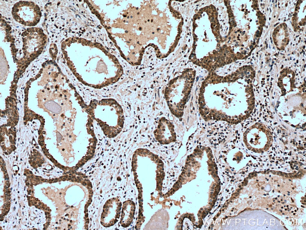 Immunohistochemistry (IHC) staining of human prostate cancer tissue using CDK2 Polyclonal antibody (10122-1-AP)