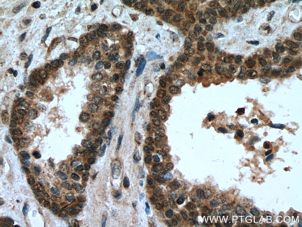 Immunohistochemistry (IHC) staining of human prostate cancer tissue using CDK2 Polyclonal antibody (10122-1-AP)