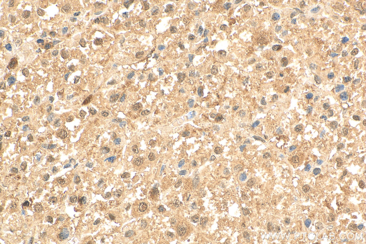 Immunohistochemistry (IHC) staining of human liver cancer tissue using CDK2 Polyclonal antibody (10122-1-AP)