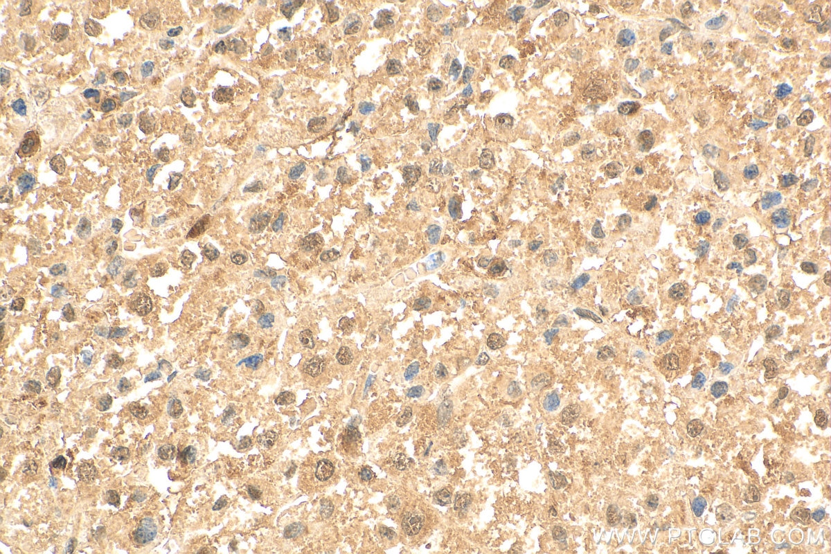 IHC staining of human liver cancer using 10122-1-AP